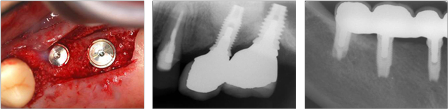 インプラント治療例
